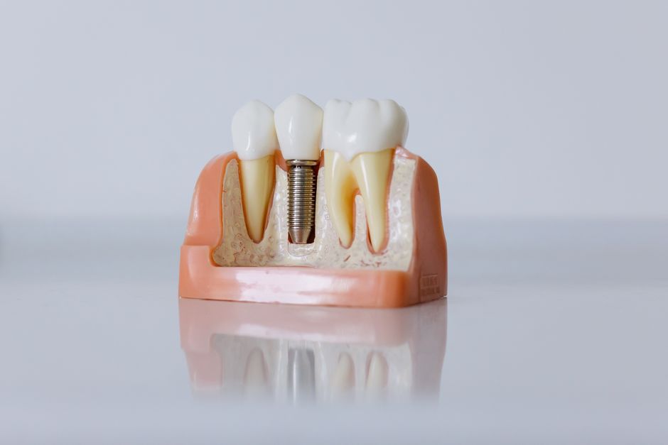 Implantul dentar — e-book